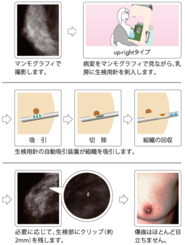 大きな 胸 に しこり 突然